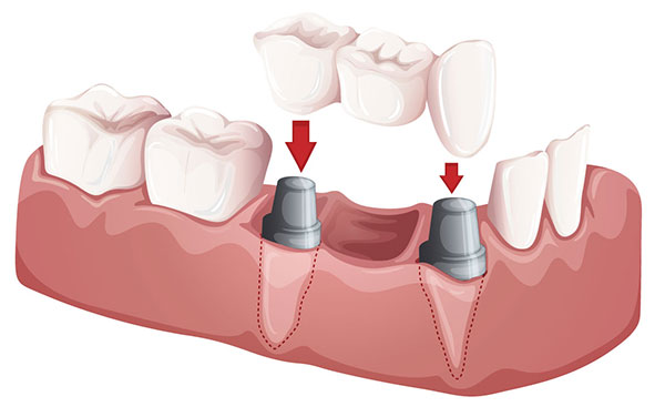 Dental Bridges Forney