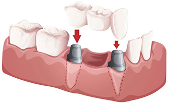 dental bridge Forney