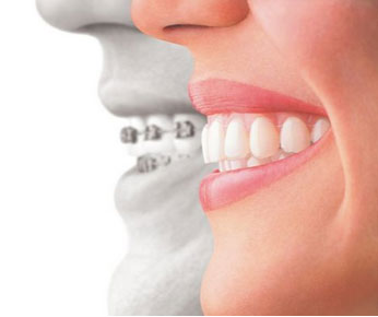 Invisalign Orthodontics Forney TX Invisalign Orthodontics Forney TX