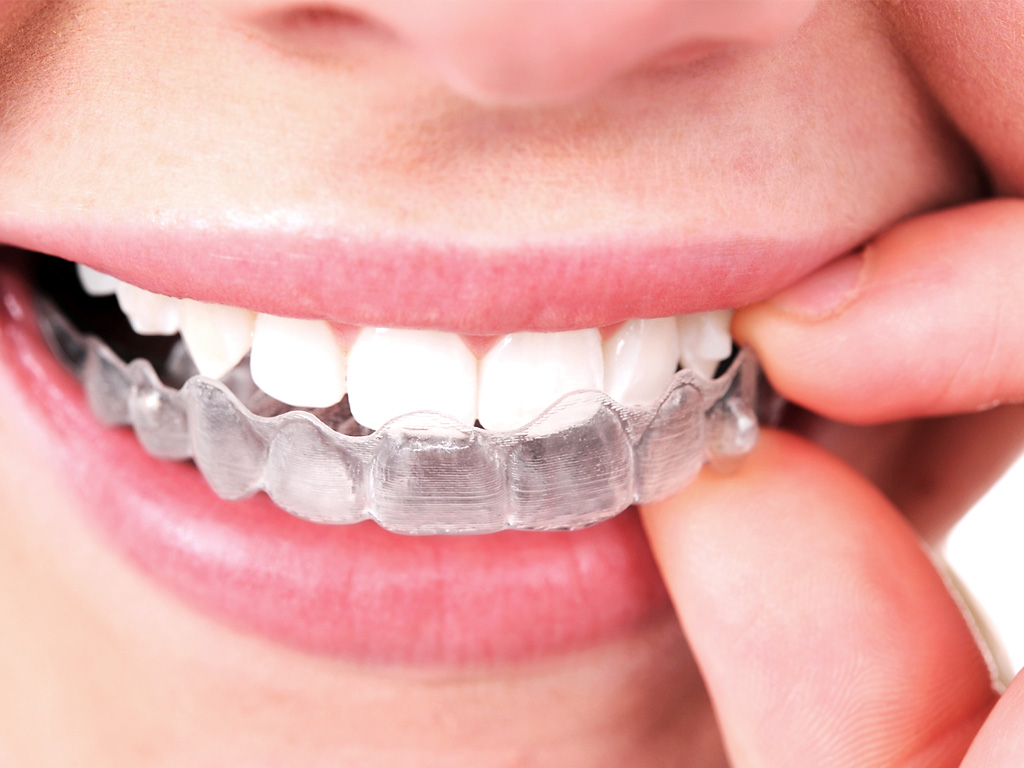 Ask Your Forney Dentist: What’s the difference between Invisalign and Metal Braces?